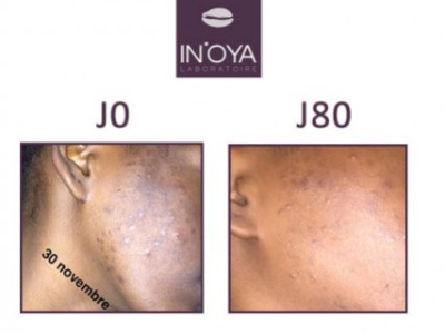 Aminata, 21 ans : Taches noires et boutons sur le visage