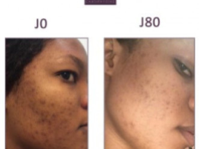 Lya, 26 ans : Taches noires tenaces sur le visage