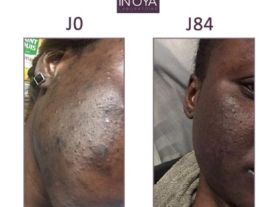 Fatou, 32 ans : Taches et boutons hormonaux 