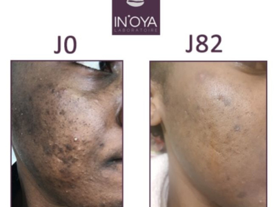 Karen, 28 ans : Taches noires et boutons sur le visage