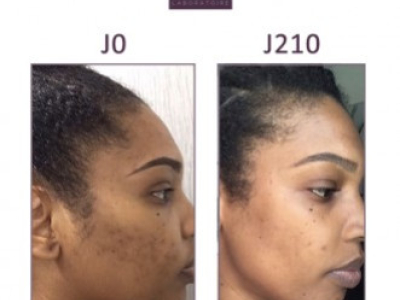 Syndie, 30 ans : Taches noires et boutons sur le visage