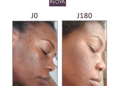 LESLIE, 32 YEARS OLD: BROWN SPOTS SCARRING ON THE FACE