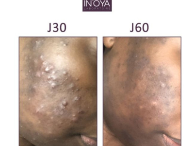 CHÉRYL, 36 YEARS OLD : PIMPLES ON HER FACE