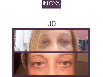 How my dark circles have faded - Fadia 54 YO