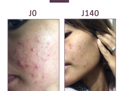 CAROLE: HORMONAL PIMPLES AND BROWN SPOTS SCARRING