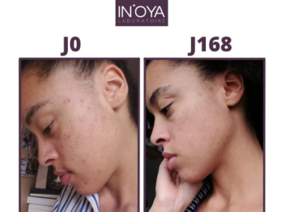 Olivia : Hormonal pimples and brown spots scarring 