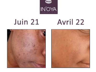 Sabrina, Sun and hormonal spots on black skin