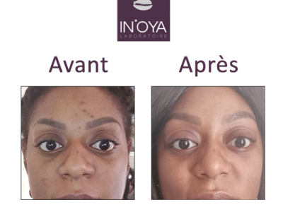 Corinne, Brown spots on the T-zone of the face